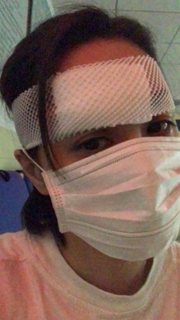 阿嬌酒店意外受傷觸目驚心，二次手術(shù)表面重縫66針
