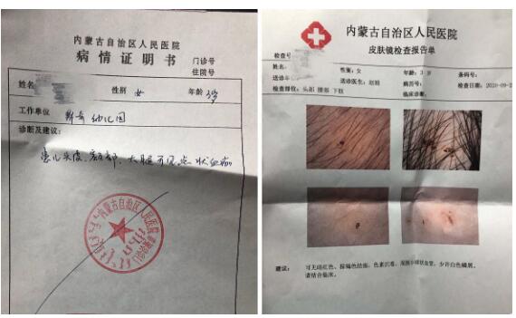孩子身上現針眼幼兒園園長被免 到底誰做的？竟然這么殘忍