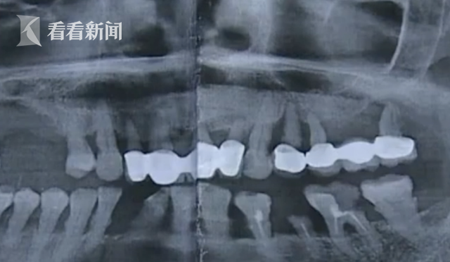 修復(fù)烤瓷牙卻被拔3顆真牙？患者：醫(yī)生只顧聊天(圖)