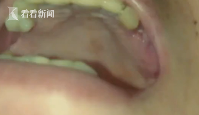 修復(fù)烤瓷牙卻被拔3顆真牙？患者：醫(yī)生只顧聊天(圖)